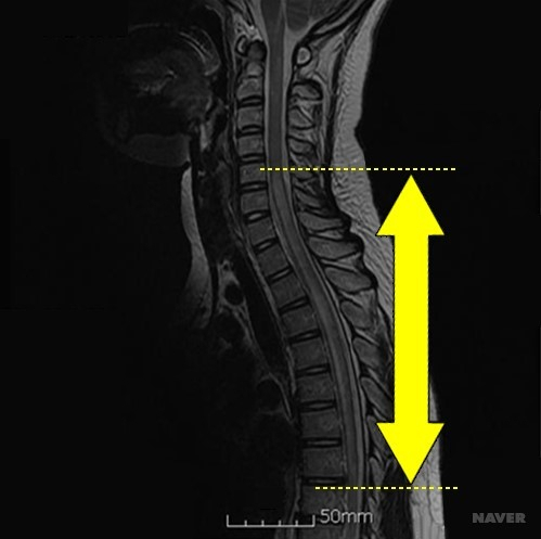 ▲ 사진=척수염 MRI / 네이버 지식백과